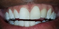 After Full Mouth Reconstructions in Los Angeles