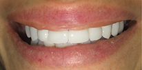 After Smile Makeover Treatment in Los Angeles CA