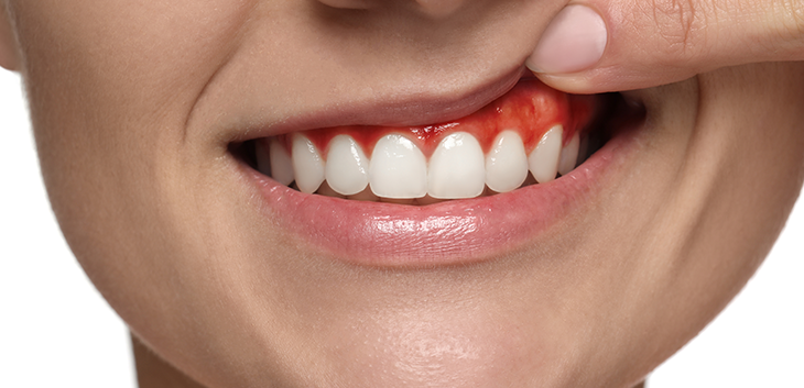 woman lifting lip to show red gums