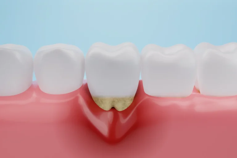 Pocket Reduction Surgery