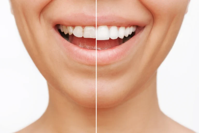 Crown Lengthening
