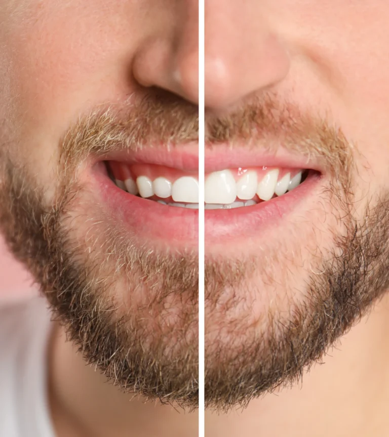 Gum Contouring