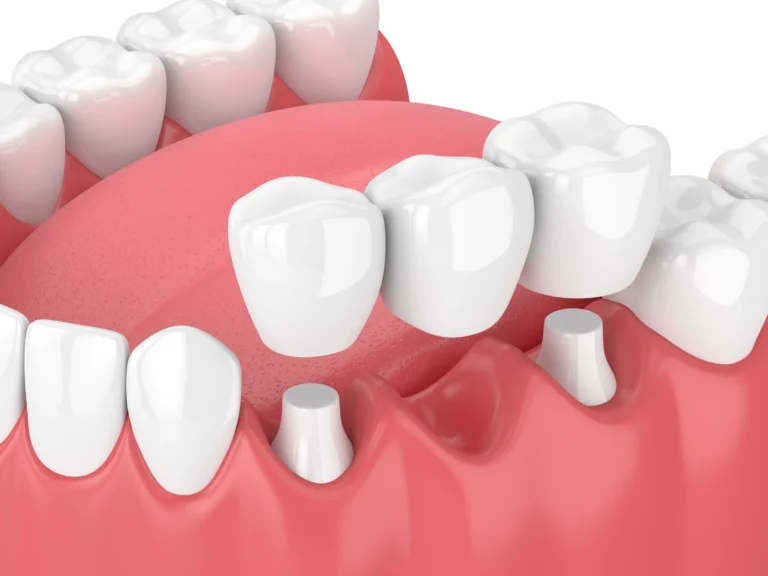 Implant Retained Crowns