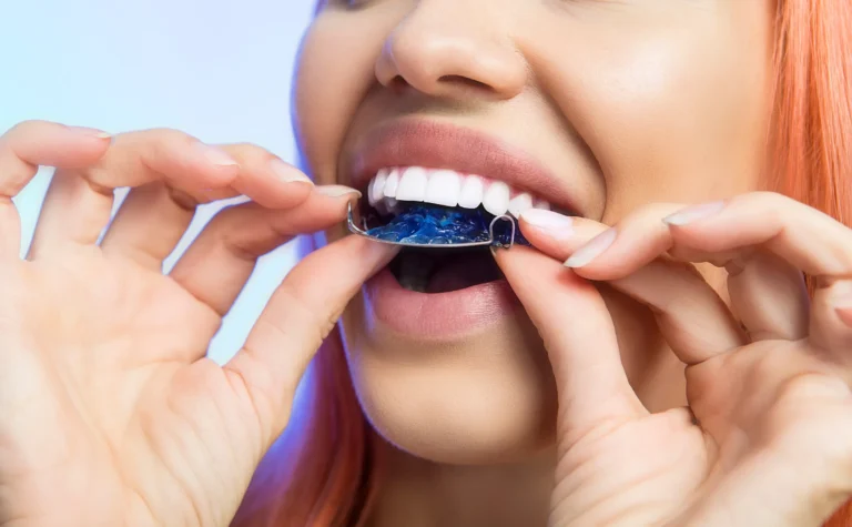 Retainer Replacement