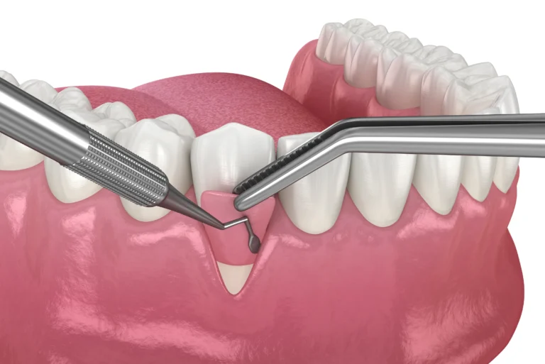 Soft Tissue Grafts