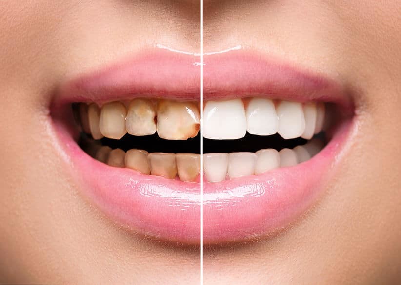 Close-up of a smile divided down the middle, stained teeth on one side and whitened teeth on the other