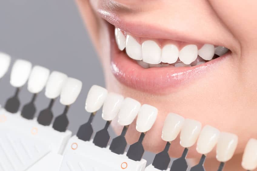 Tooth shade guide held against a smile to match the color