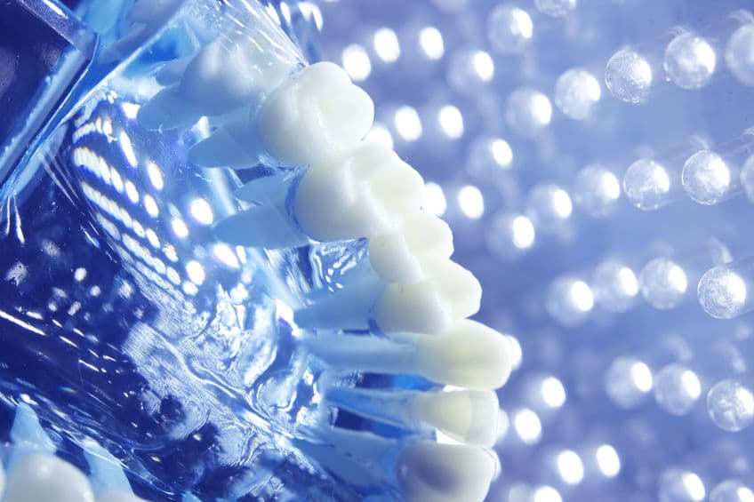 Close-up of a model showing crowns fitted onto dental implants