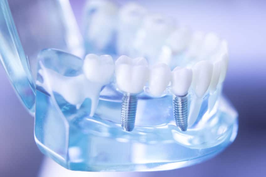 Translucent model of a lower jaw fitted with dental implants