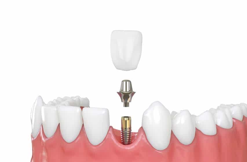 Rendering of a dental implant, abutment and crown above a gap in the lower teeth