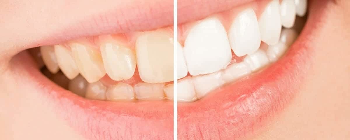 Side-by-side comparison of yellowed teeth and whitened teeth