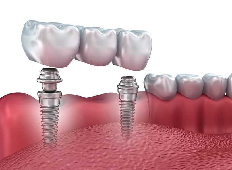 Rendering of an implant-supported bridge set into the jaw