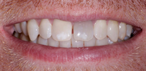 Smile LA case 01, before treatment
