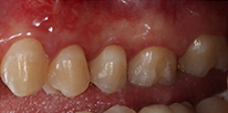 Smile LA case 05, after treatment