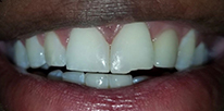 Smile LA case 06, before treatment