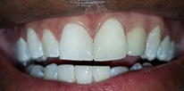 Smile LA case 06, after treatment