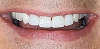 Smile LA case 07, after treatment