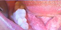 Smile LA case 08, after treatment