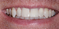 Smile LA case 01, after treatment