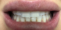 Smile LA case 02, before treatment
