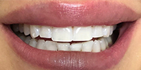Smile LA case 02, after treatment