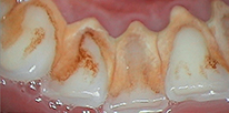 Smile LA case 03, before treatment