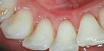 Smile LA case 03, after treatment
