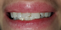 Smile LA case 04, before treatment