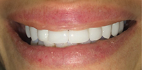 Smile LA case 04, after treatment
