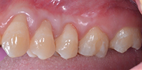 Smile LA case 05, before treatment