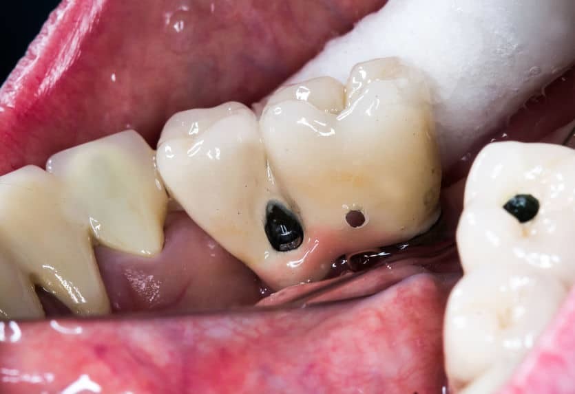 Close-up of molars with dark areas of decay
