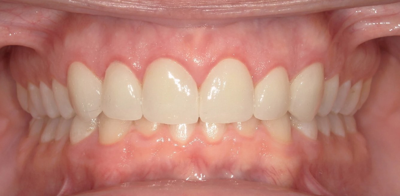 Smile LA case 09, after treatment
