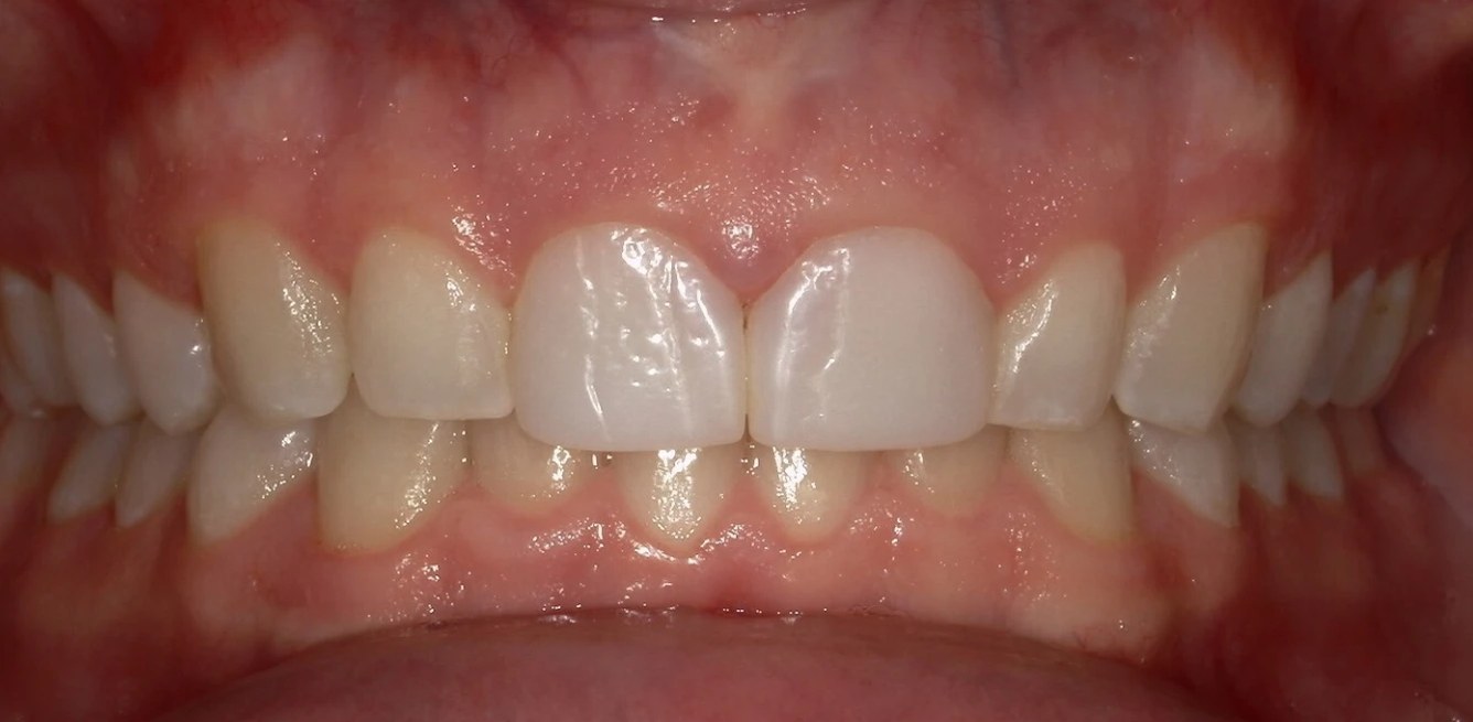 Smile LA case 09, before treatment
