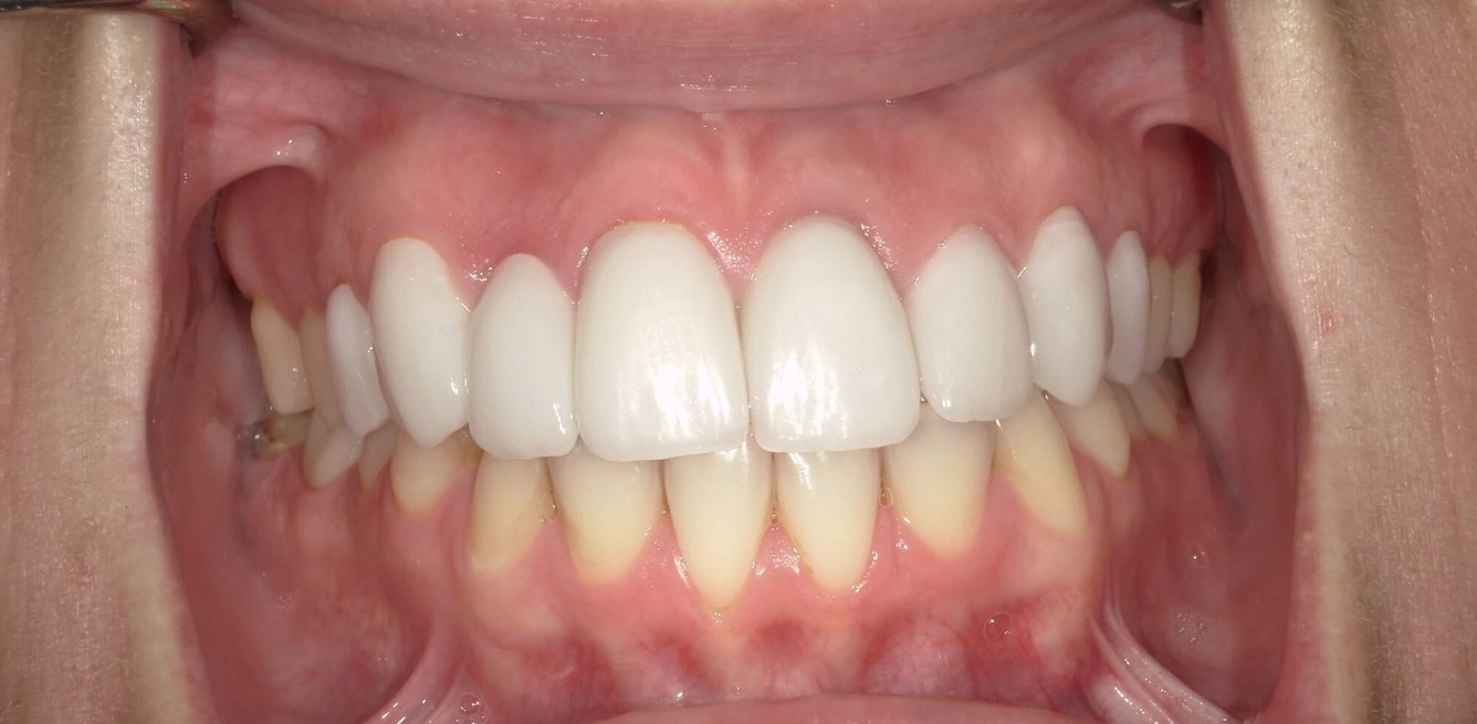 Smile LA case 10, after treatment
