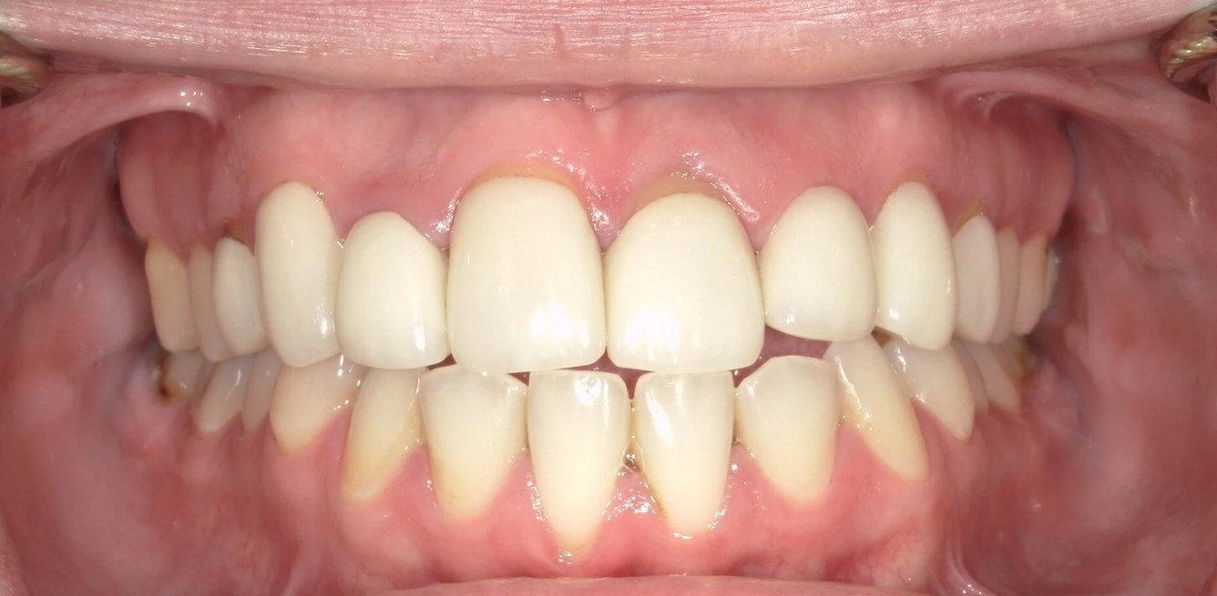 Smile LA case 10, before treatment