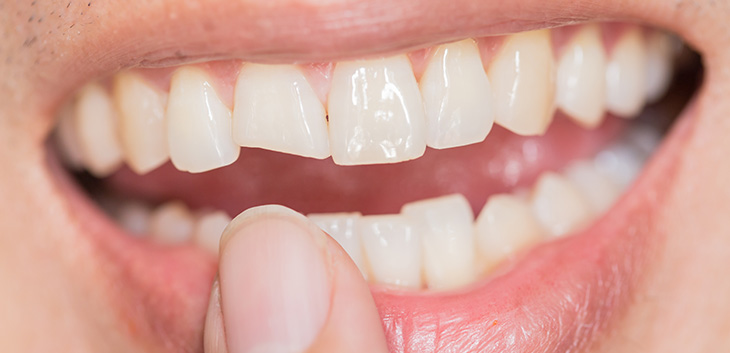 Finger pointing to a chipped tooth