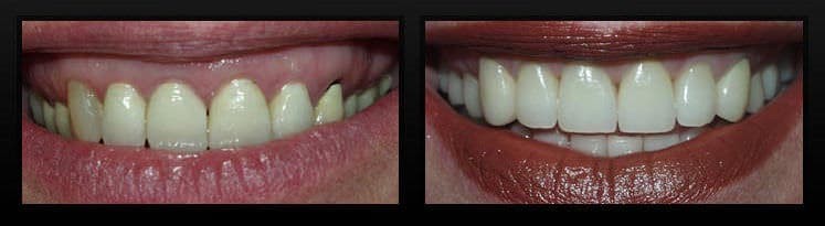 Before and after photographs of a treated gum line