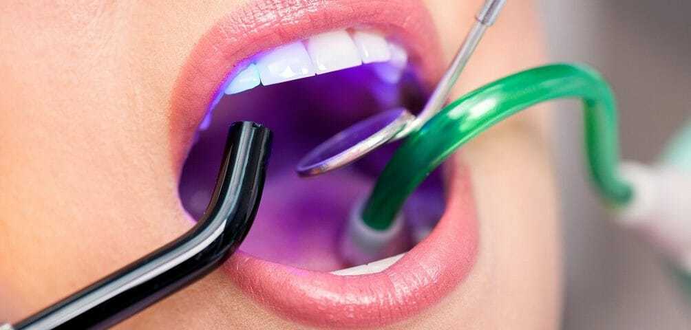 Close-up of a curing light setting a filling in a patient's mouth