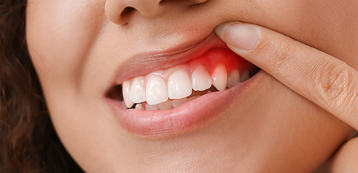 Woman lifting her lip to show an inflamed gum