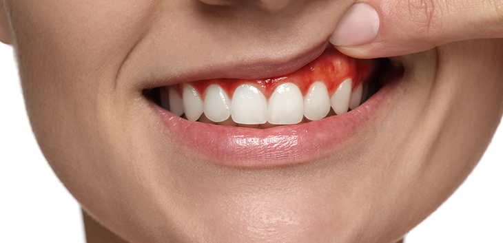Woman lifting her lip to show reddened gums