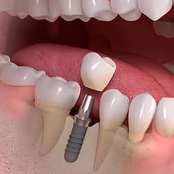 Rendering of a single-tooth implant placed in the jaw between natural teeth