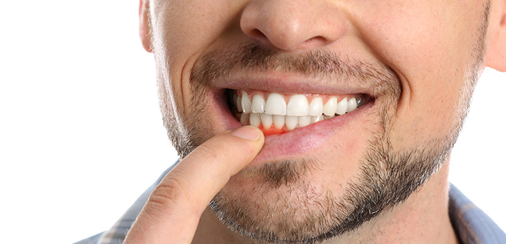 Man pulling down his lip to reveal an inflamed gum