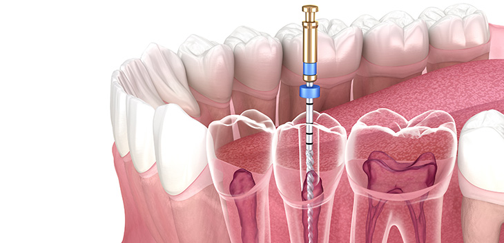 Rendering of root canal therapy inside a tooth
