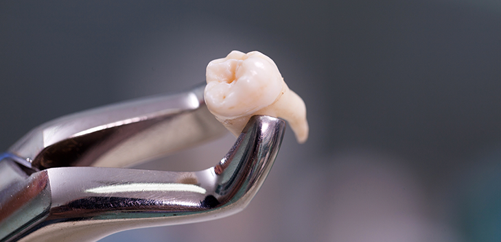 Forceps holding an extracted tooth