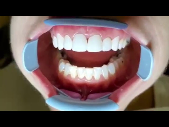 A patient speaking to camera about their treatment at Smile LA