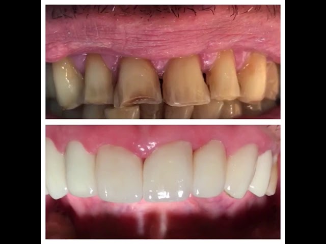 A patient speaking to camera about their treatment at Smile LA