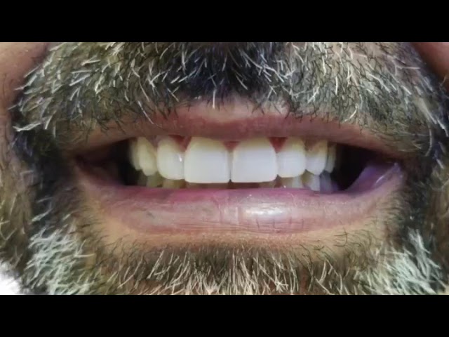 A patient speaking to camera about their treatment at Smile LA